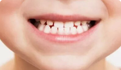 兒童口腔面顎發育 什麼導致牙齒排列不整齊？